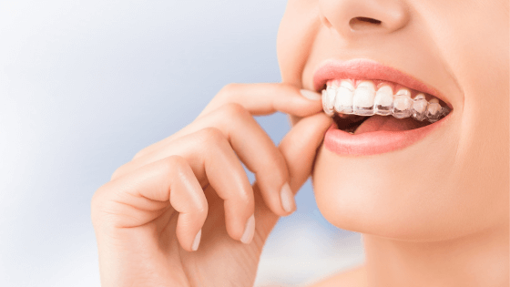 Invisalign Treatment